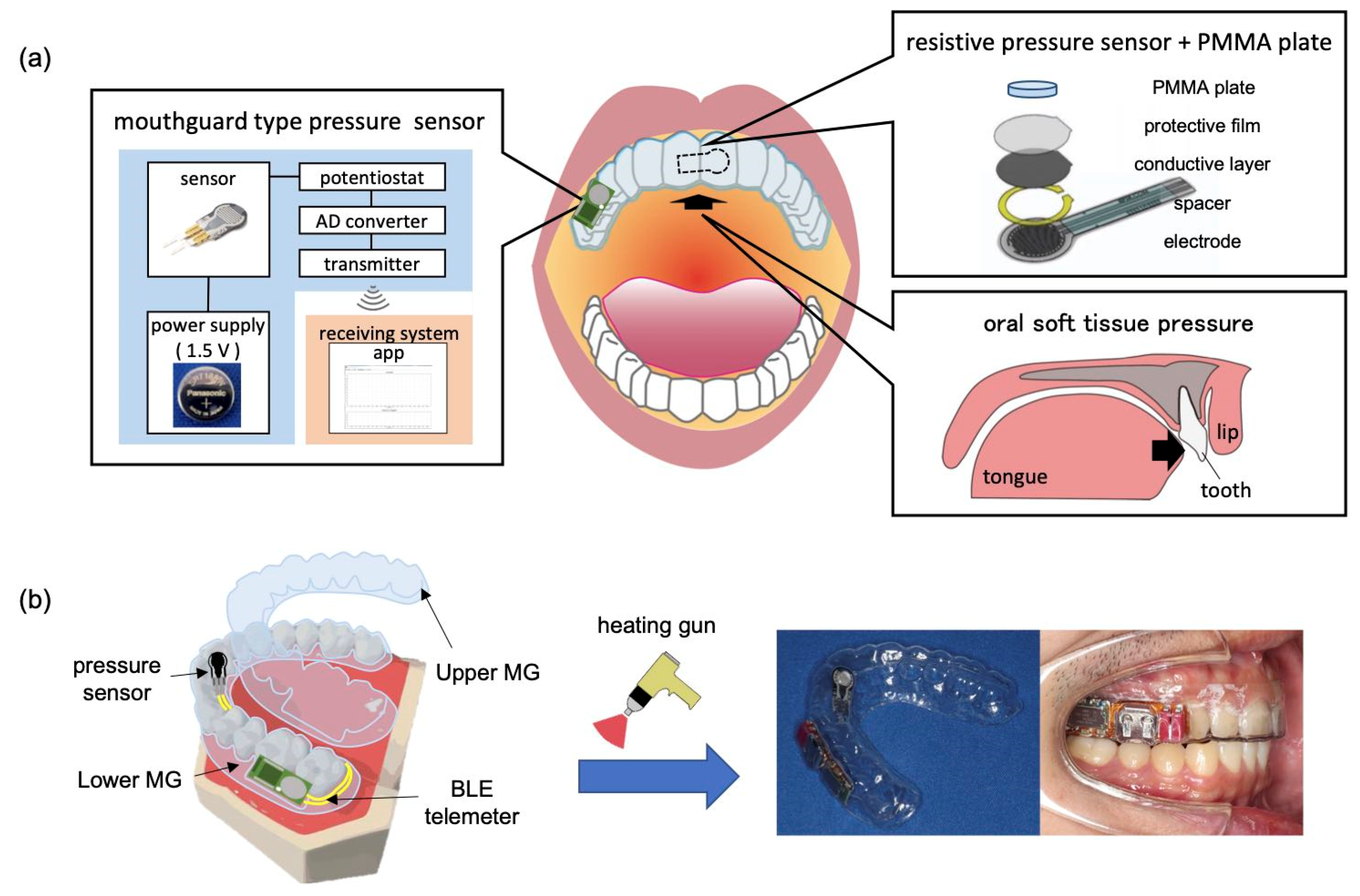 Real-Time Continuous Monitoring of Oral Soft Tissue Pressure with a Wireless Mouthguard Device for Assessing Tongue Thrusting Habits