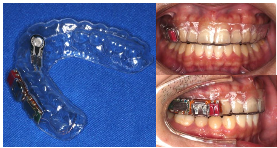 Real-Time Continuous Tongue Pressure Measurement With Mouthguard-Type Pressure-Sensing Device
